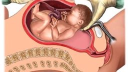 <b>2. </b>7 reasons why Cesarean Section is better than Natural Labor