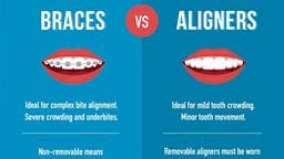 <b>5. </b>What are the main differences between Braces and Aligners?