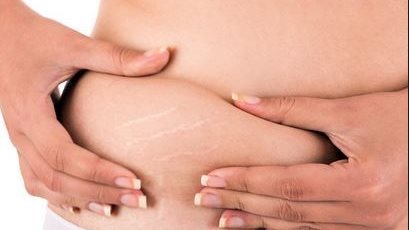 Believe it or not ... many men find stretch marks attractive!