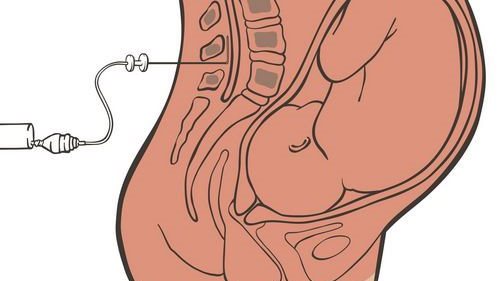 هل ابرة الظهر مؤلمة فعلا وقاتلة للألم في آن؟!