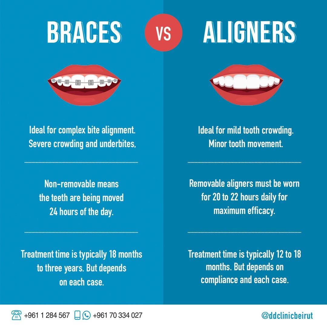 What Are The Main Differences Between Braces And Aligners